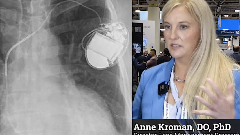 Anne Kroman, DO, PhD, Medical University of South Carolina, discusses trends in EP device lead management.