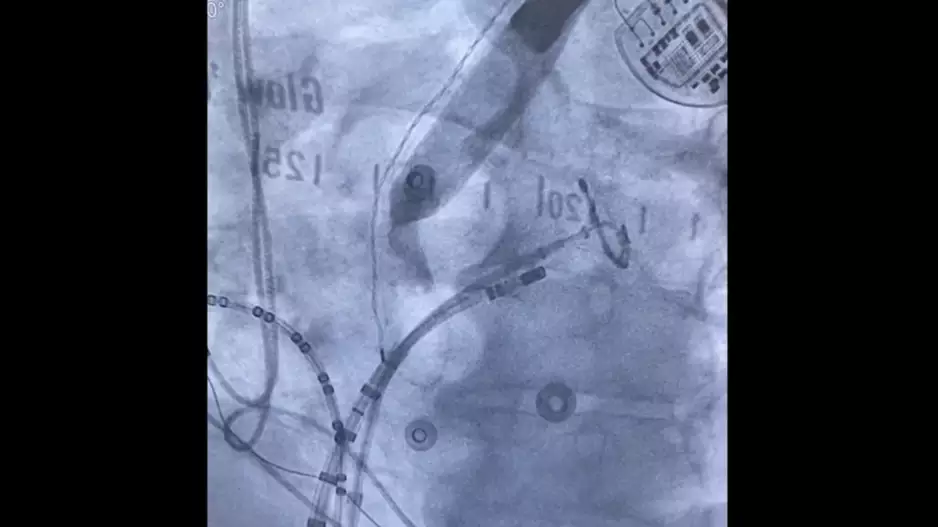 Esolution device S4 Medical PFA ablation esophagus 