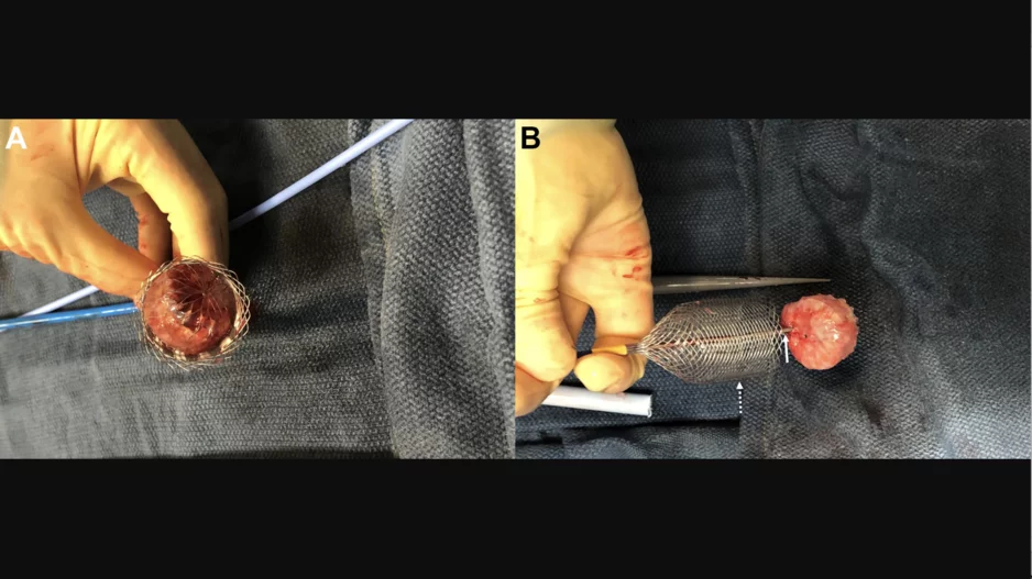 Hoping to improve care for these patients, Hermann et al. turned to the ŌNŌ retrieval system, a catheter-delivered device cleared by the U.S. Food and Drug Administration in 2022. The device was developed by Ōnōcor, a U.S. healthcare startup with roots in the Penn Center for Innovation. 