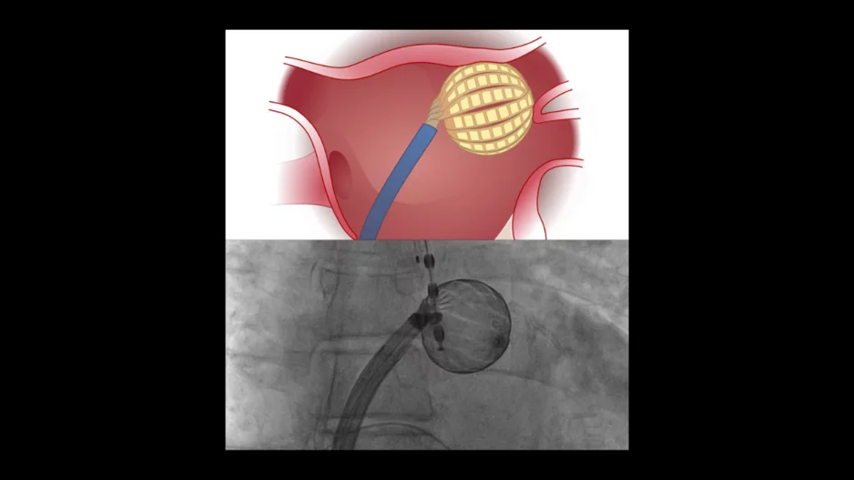 mages of the Globe Pulsed Field System courtesy of Kardium