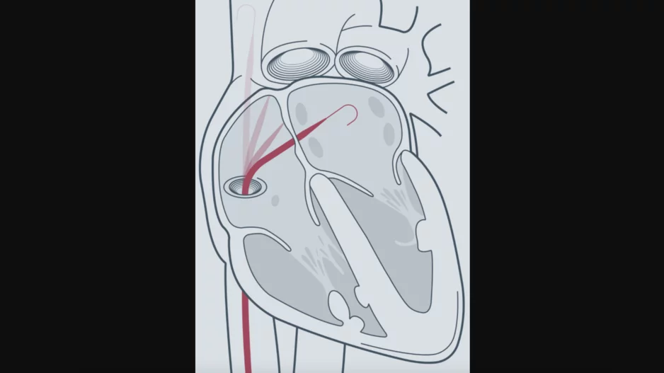 Atraverse Medical Hotwire radiofrequency (RF) guidewire