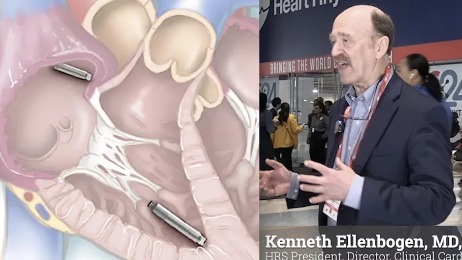 Heart Rhythm Socity (HRS) President Kenneth Ellenbogen, MD, explains key electrophysiology (EP) trends at the HRS 2024 meeting. #HRS #HRS24 #HRS2024 #EPeeps