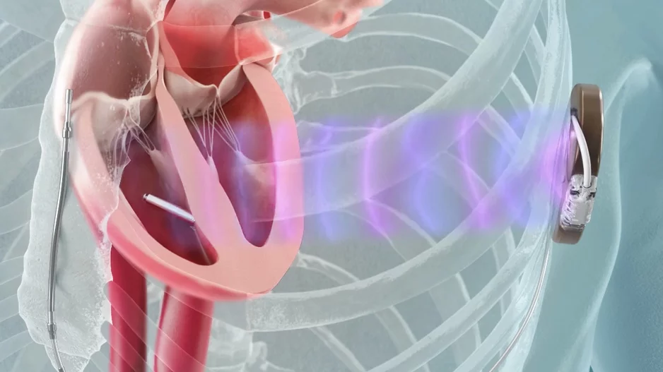 The MODULAR ATP study demonstrated a high rate of successful leadless pacemaker implantation with few complications and stable pacing parameters. The system uses the Emblem Subcutaneous Implantable Defibrillator (S-ICD) System and the new Empower Leadless Pacemaker from Boston Scientific.
