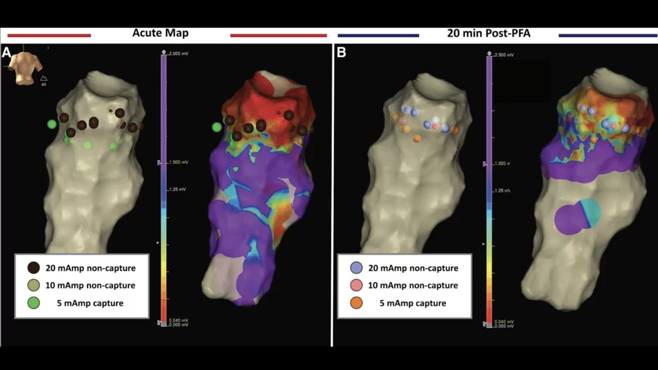 Focal pulsed field ablation (PFA) is a safe, effective treatment option for premature ventricular contractions (PVC), according to new data published in Circulation: Arrhythmia and Electrophysiology.[1]