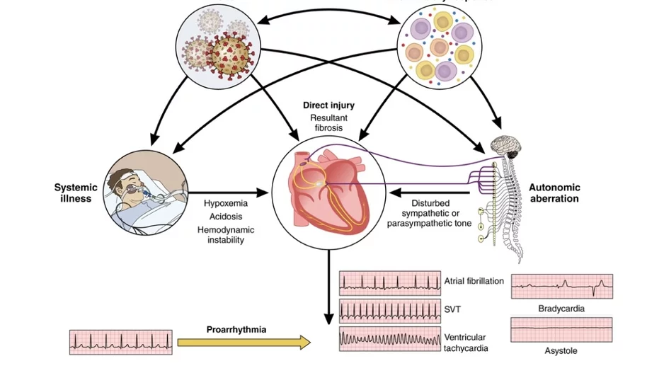 Overview of the pathophysiological mechanisms associated with arrhythmogenesis in the setting of COVID-19 infection. Image from Circulation.