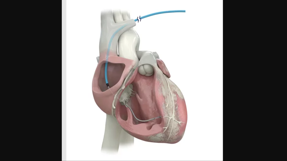 The OmniaSecure defibrillation lead, which Medtronic describes as “the world's smallest transvenous defibrillation lead,” has a size of just 4.7 French.