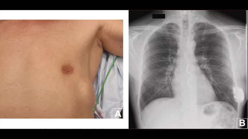 Cardiologists have performed what they believe to be the world’s first substernal lead extraction, sharing their experience in JACC: Case Reports.[1]The device being extracted, Medtronic’s Aurora EV-ICD, received U.S. Food and Drug Administration (FDA) approval in October 2023.