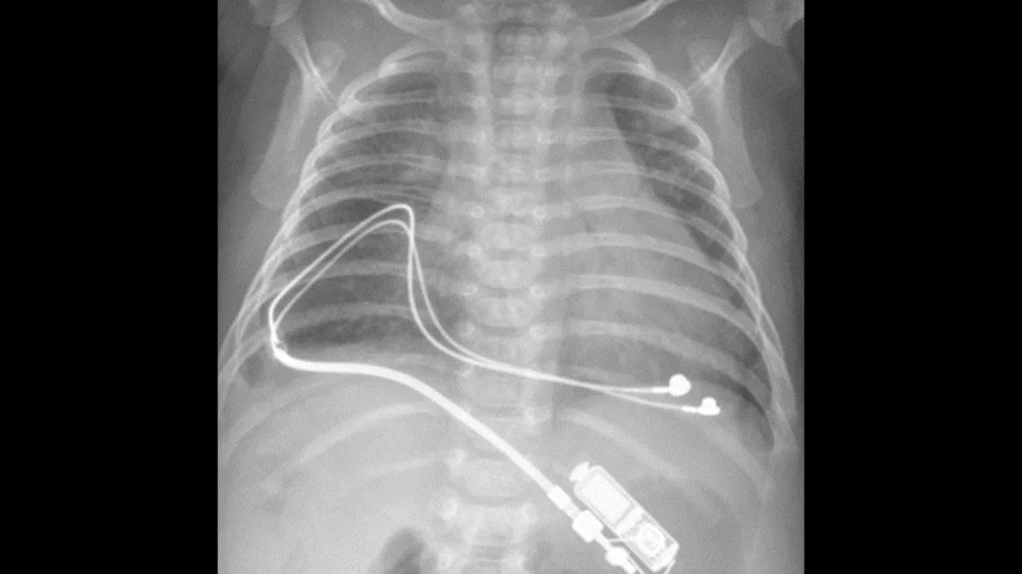 pediatric pacemaker