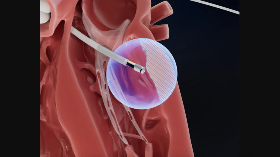 Field Medical FieldForce Ablation pulsed field ablation