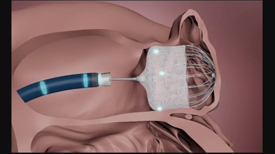 Watchman TruSteer Access System