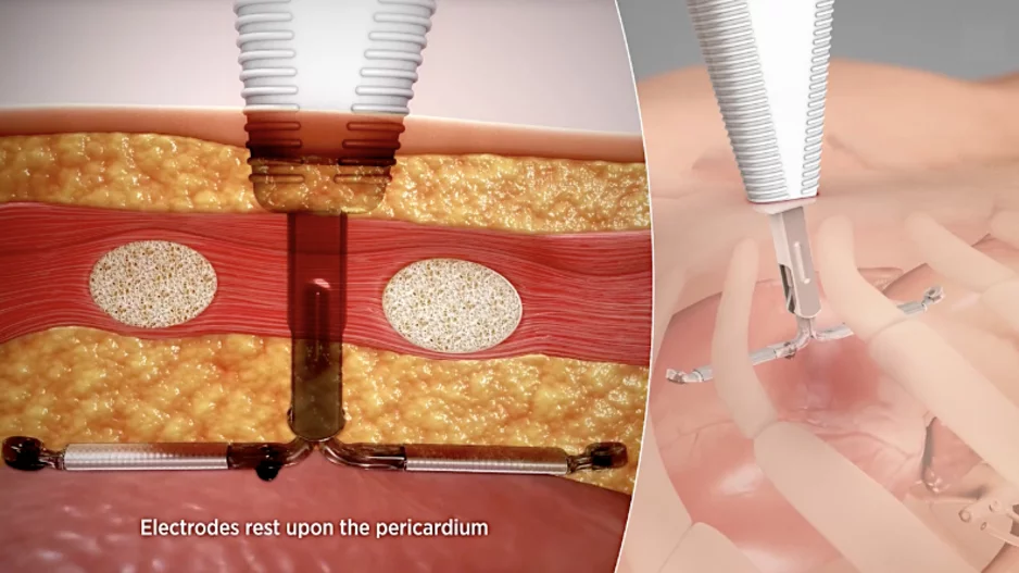 Abbott recently announced it is partnering with AtaCor Medical to develop a next-generation extravascular implantable cardioverter defibrillator (EV-ICD) system. AtaCor's investigational extravascular ICD lead will be paired with Abbott's investigational extravascular ICD system. 