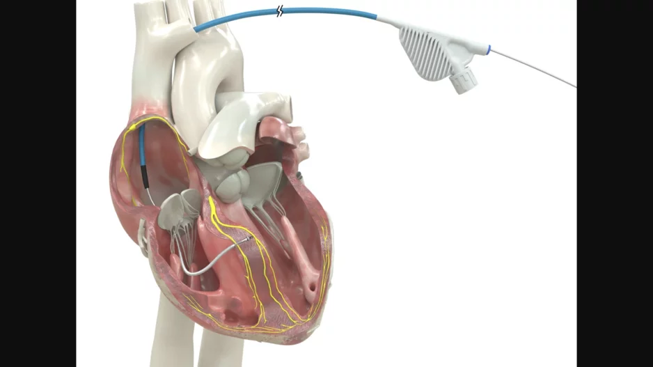 OmniaSecure defibrillation lead approved by FDA for placement in LBB area