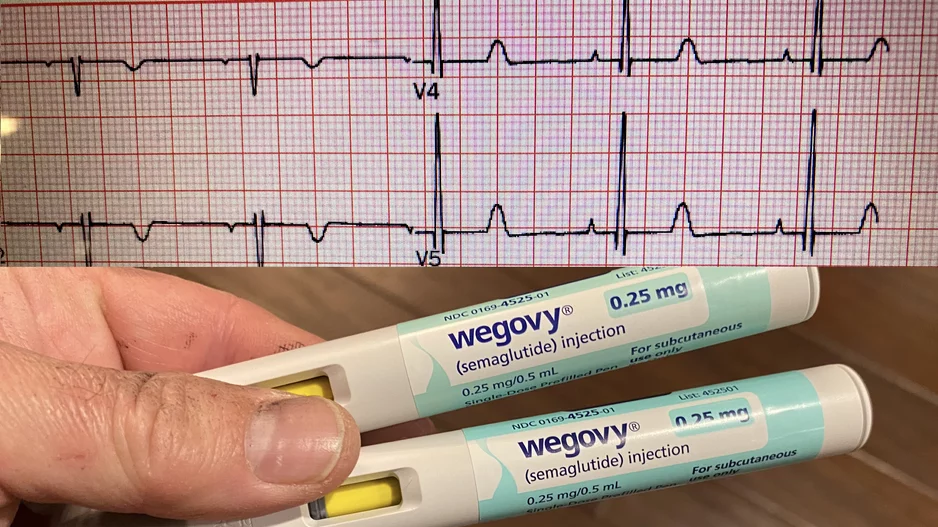 GLP-1 receptor agonists (GLP-1-RAs) have become the wonder drug not only of weight loss, but also for improving cardiovascular health in a growing number of positive cardiovascular trials. The latest study of more than 13,000 patients presented at Heart Rhythm 2026 this week showed the GLP-1 reduce atrial fibrillation (AFib) and survival, even after accounting for the drug’s impact on weight loss. 
