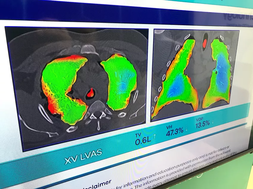 Dynamic lung air flow analysis just using X-ray without any contrast with new technology from 4D Medical.