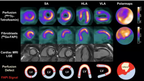 SNMMI Image of the Year 68Ga-FAPI-46 PET/CT heart attack acute myocardial infarction