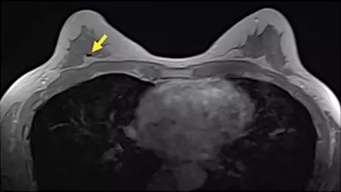 Breast MRI example showing a signal void in right breast (arrow) caused by biopsy on an axial contrast-enhanced in-phase Dixon image. It shows a signal void in right breast (arrow), which corresponded with a MammoMark/CorMark Bread Tie biopsy clip. Image courtesy of AJR.