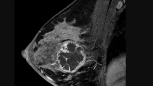 Sagittal images from breast MRI in a 36-year-old woman with an invasive ductal carcinoma. Image from pre-chemotherapy contrast-enhanced T1-weighted MRI shows a round, rim-enhancing mass. This  subtraction image shows the maximal diameter of the mass was measured up to 5.4 cm. Read more. RSNA image. What does breast cancer look like?