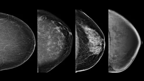 Example of the four types of breast tissue density. The density of fibroglandular tissue inside the breast impacts the ability to easily see cancers. Cancers are very easy to spot in fatty breasts, but are almost impossible to find in extremely dense breasts. These examples show craniocaudal mammogram findings characterized as almost entirely fatty (far left), scattered areas of fibroglandular density (second from left), heterogeneously dense (second from right), and extremely dense (far right). RSNA