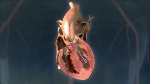 Impella Heart Pump Abiomed RECOVER IV RCT cardiogenic shock