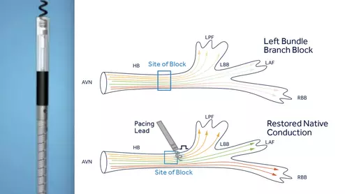 The Medtronic SelectSecure MRI SureScan Model 3830 cardiac lead already gained FDA approval for His-Bundle pacing back in 2018. Now, the lead is also approved for left bundle branch area pacing, providing users with another option when treating patients for bradycardia. According to Medtronic, this marks the first time the FDA has approved a device for this indication.