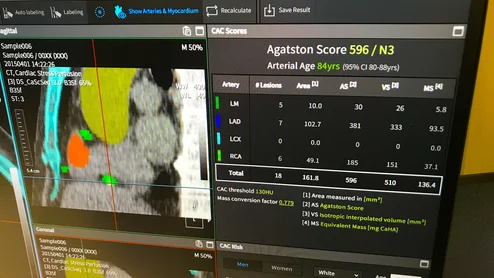 An example of artificial intelligence automated coronary artery calcium scoring shown by Coreline at ACC23. The AI also identifies and color codes the anatomy so help show the reviewing radiologist or cardiac imager what and where things were calculated. #ACC #ACC23