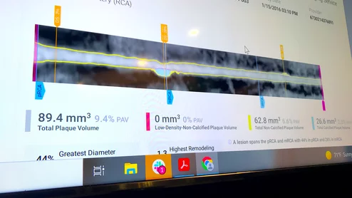 Example of an automated artificial intelligence (AI) assessment of soft coronary plaque from a CT scan from the vendor Cleerly. The AI gives a very detailed report of all the plaque in all the coronary vessels. Some cardiology experts believe this may be the way of the future in screening patients for early coronary disease and monitoring the impact of prevention efforts such as statins to determine if more aggressive treatments are needed.