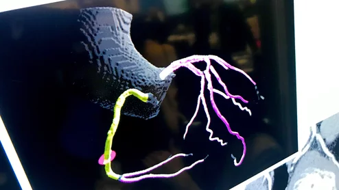 Example of an automated artificial intelligence (AI) assessment of soft coronary plaque from a CT scan from the vendor Cleerly. This image shows the AI's reconstruction of a patient's coronary tree and color codes the vessel segments by the amount of overall plaque burden. The AI gives a very detailed report of all the plaque in all the coronary vessels. Some cardiology experts believe this may be the way of the future in screening patients for early coronary disease and monitoring the impact of prevention 