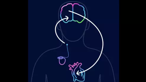 CVRx Barostim illustration