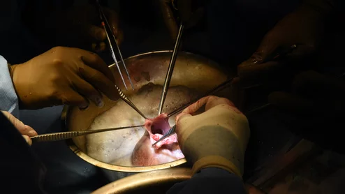 Surgeons transplanting a pig heart into a human patient. 