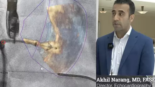 Akhil Narang, MD, director of the echocardiography laboratory at Northwestern Medicine explains the latest trends in structural heart interventional imaging. #ASE #ASE23 #ASE2023 #structuralheart #echofirst 