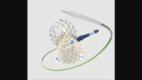 Medtronic's Evolut FX TAVR valve, designed with 3 golden markers that improve alignment