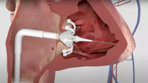 The Evoque transcatheter tricuspid valve replacement (TTVR) system for tricuspid regurgitation from Edwards Lifesciences