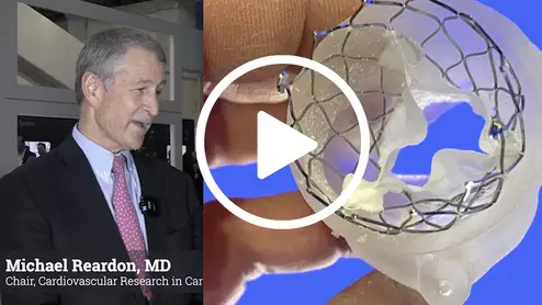 Video of Michael Reardon, MD, explaining details from the Evolute Low Risk 4-year results at TCT 2023.