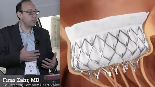 Firas Zahr, MD, Oregon Health and Science University, discusses the one-year outcomes for transfemoral transcatheter mitral valve replacement (TMVR) in the Medtronic Intrepid Early Feasibility Study presented at TCT 2023.