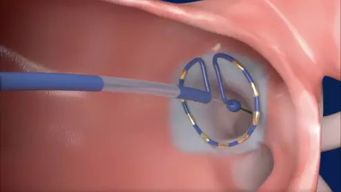 Medtronic's PulseSelect Pulsed Field Ablation (PFA) System 