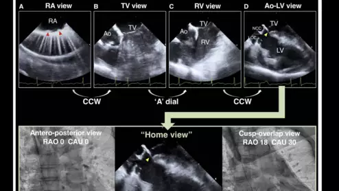 Self-expandable TAVR cusp-overlap ICE