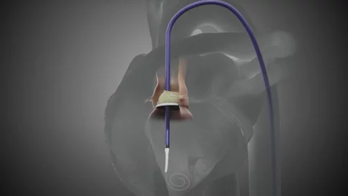 Pi-Cardia ShortCut TAVR device