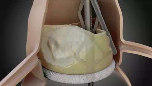 Pi-Cardia ShortCut TAVR device