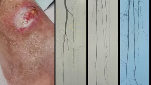 A diabetic foot ulcer that does not heal due to low blood supply from peripheral artery disease (PAD), and the before and after interventional angiograms of the patient's revascularization treatment. Images courtesy of Foluso Fakorede, MD