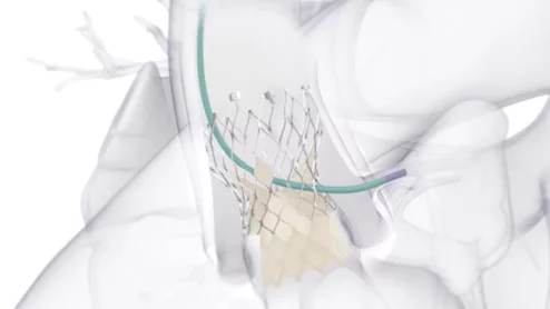 Medtronic's Evolut Pro TAVR valve treating aortic stenosis
