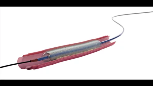 Boston Scientific’s Agent Drug-Coated Balloon (DCB), which delivers a therapeutic dose of the anti-proliferative drug paclitaxel to the patient’s scar tissue to prevent ISR from recurring, gained FDA approval on March 1.. 