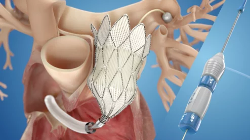 Transcatheter pulmonary valve replacement (TPVR) with Medtronic’s self-expanding Harmony valve is both safe and effective after more than a year, according to new real-world data published in the Journal of the American College of Cardiology.[1]