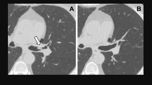 Lung cancer screening CT image in a 66-year-old male patient shows a sessile nodule with internal air in the left mainstem to left upper lobe bronchus (arrow) with a mean diameter of 10 mm. The nodule was assigned as Lung-RADS category 4A in the clinical report. (B) Follow-up CT image shows the lesion is resolved. Image courtesy of RSNA