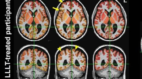 light therapy improves brain connectivity after head trauma