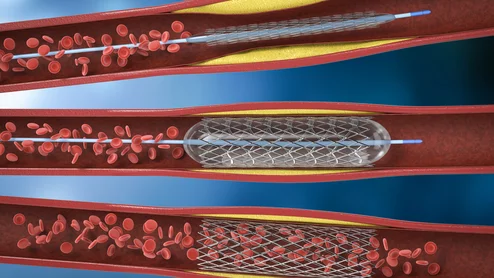 PCI interventional cardiology