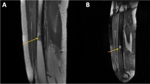 osseous lesion on MRI.