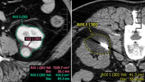 renal cryoablation volumes