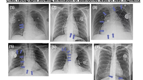Some of the abandon leads and various shapes and positions on the wires from the study. None of these patients had any safety issues related the abandoned leads. Image courtesy of RSNA