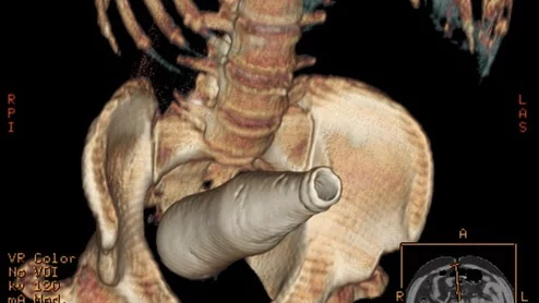 CT scan of a Coca-Cola bottle rectal foreign body. There are a sizable number of emergency room cases each year for items people insert into their rectums that become lodged or lost inside the colon. This includes many types of household items beyond vibrators and commercially made butt plugs. Ghonaim E, Rectal foreign body. Case study, Radiopaedia.org.