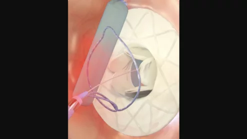 Adona Medical adjustable interatrial shunt